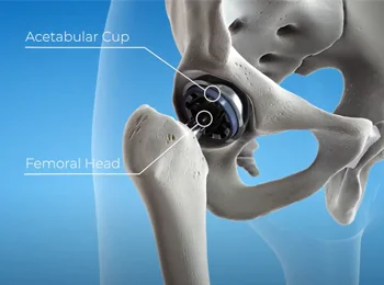 GYDER™ HIP SYSTEM | Design and Engineering | Hydrix